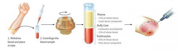 P -SHOT PRP Platelet Rich Plasma Erectile Dysfunction and Peyronies treatments Platet Rich Plasma