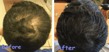 Male Pattern Hair Loss Non Surgical Hair Restoration
