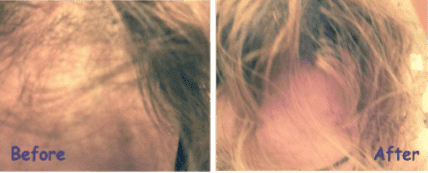 Woman Non-Surgical Hair Restoration PRP Stem Cells