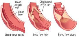 High blood cholesterol causes fatty plaque to build up in arteries that bloocs blood flow... RejuvaWAVE shock wave ED therapy West Palm Beach Boca Raton stops reverses the narrowing of blood vessels and cures ED