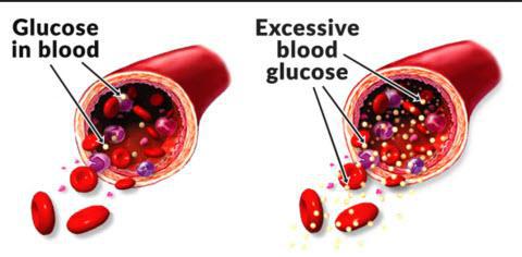 High blood sugar damages blood vessels causing Erectile Dysfunction - Simply Men's Health ED Shockwave cure