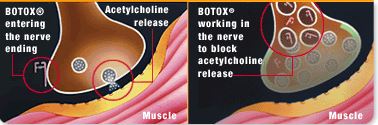 Botox how it works